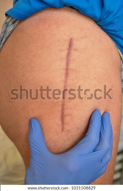 Medicine\
doctor check scar. Patient  hip joint that was affected by\
arthritis and replacing it with an artificial joint.  Detail of\
skin after replacing of the devastated hip\
join.