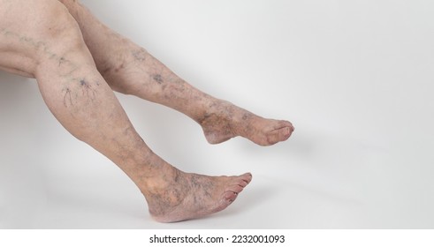 Medicine and health. The concept of female varicose veins. Female profile legs with varicose veins, on a white background. VARICOSITY, legs of an older unrecognizable woman. Copyspace.