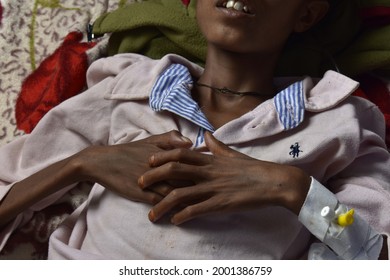 Mekele, Tigray, Ethiopia - 01 June 2021: The Victims Of The Famine On The Hospital Beds