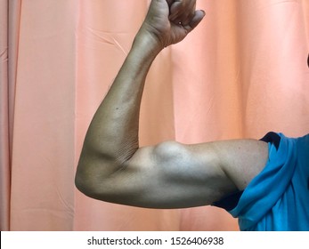 Melaka, Malaysia - Circa October 2019 : Right Arm Flexing Shows A Prominent Bicep Tendon Rupture ( Popeye Sign )