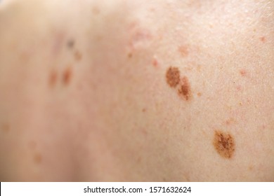 A melanocytic nevus also known as nevocytic or nevus-cell nevus and commonly as a mole is a type of melanocytic tumor - Shutterstock ID 1571632624