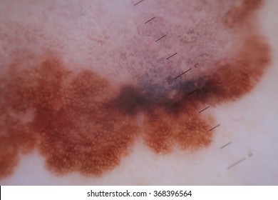 Melanoma