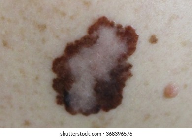 Melanoma