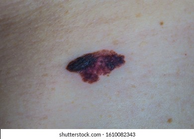 Melanoma - A Malignant Tumor Of Human Skin