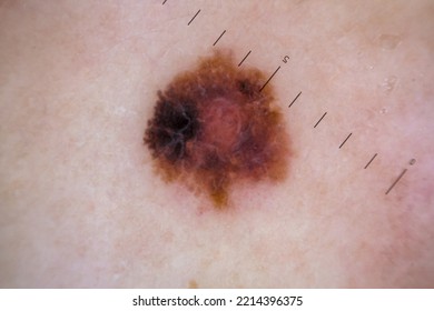 Melanoma Is A Malignant Tumor Of The Human Skin