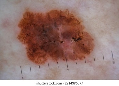 Melanoma Is A Malignant Tumor Of The Human Skin