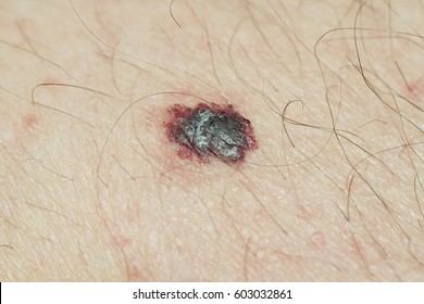 Melanoma Skin Disease