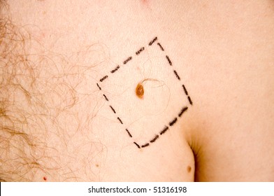 Melanoma With Surgery Drawed Lines