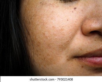 Melasma And Freckle On Woman Face      