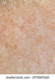 Melasma  Lentigo On The Skin Of A Man Macro Photo. Skin Pigmentation Melasma Hyper-pigmentation With Age, Pigment Spots, Skin Aging