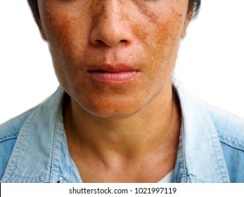 Melasma On Woman Face, Skin Problem      