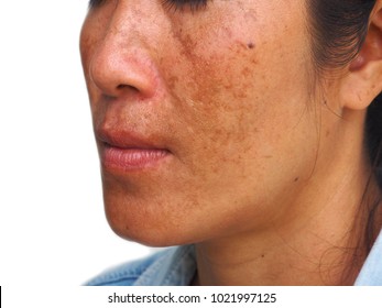 Melasma on woman face, skin problem
