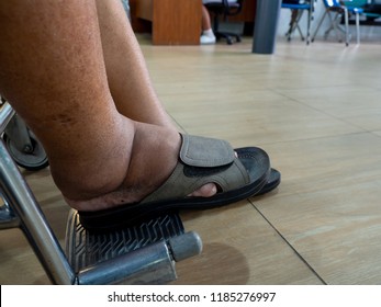 Men With Diabetes And Kidney Disease With Swelling Feet. Can Not Wear Shoes. He Was In A Wheelchair In The Hospital For A Battle To See A Doctor For Treatment.