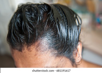 Similar Images Stock Photos Vectors Of Close Up Of Balding And