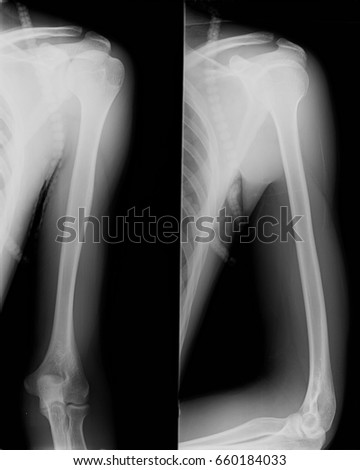 men elbow xray stock photo edit now 660184033 shutterstock elbow xray