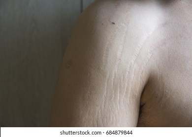 Male Stretch Marks Images Stock Photos Vectors Shutterstock