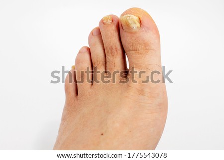 
Men foot with callus on big toe and on small toes and a case of fungal infection of the nail. White, yellow discoloration, thickening and separation from the nail bed. Before treatment.