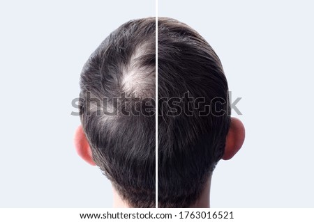 Men hair after using cosmetic powder for hair thickening. Crown with bald head. Before and after.