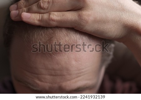 Men hair loss problem alopecia, closeup shallow focus photo