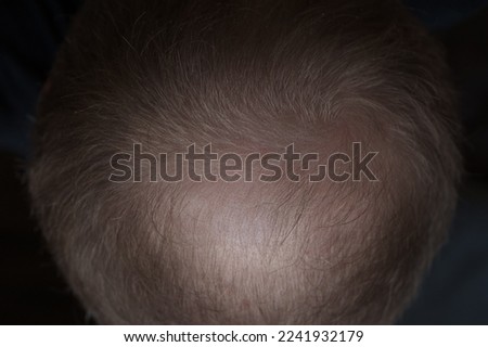 Men hair loss problem alopecia, closeup shallow focus photo