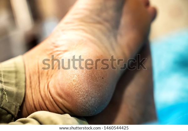 mens dry cracked feet