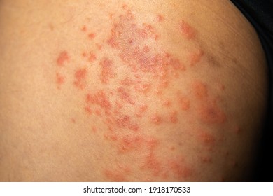 Men scratching legs suffering strong allergy skin itchy symptom, Allergy rash and Health problem.
