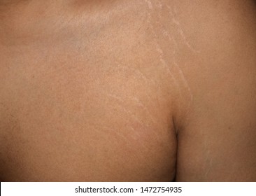 Men Show Stretch Marks Chest And Shoulder On White Background