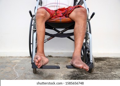 Men With Unusual Legs Small And Unequal, Sitting On A Wheelchair Sick With Polio