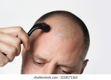 Men using microneedle derma roller on head for stimulating new hair growth. Simple and cheap treatment for alopecia.