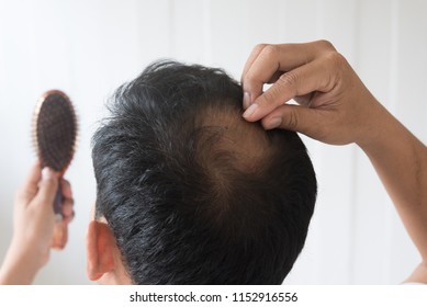 Men Are Worried About Hair Loss.