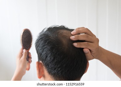 Men Are Worried About Hair Loss Problem.