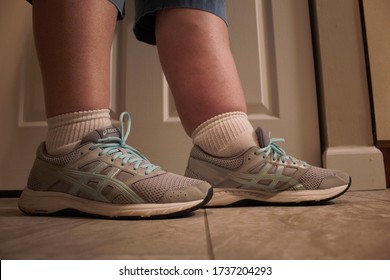 Menomonee Falls, WI / USA - May 15, 2020: A Woman With Lymphedema Compares Her Normal Leg To Her Swollen Leg, Which Is Caused By A Lymphatic System Blockage.