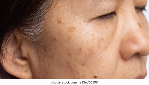 Menopausal women worry about melasma on face. - Shutterstock ID 2136766199