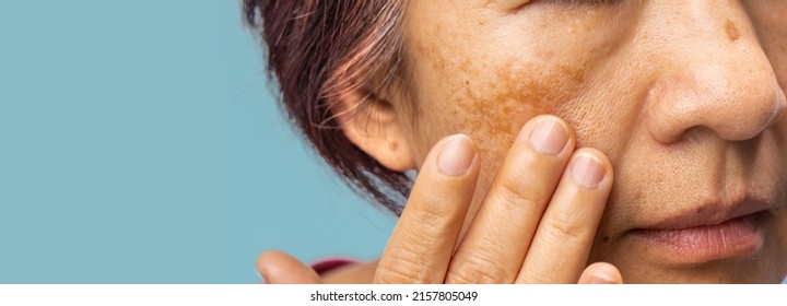 Menopausal Women Worry About Melasma On Face.