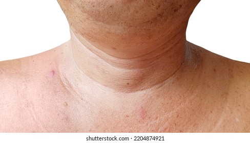 Men's Chest Skin Has Scars, Freckles Sunburn.