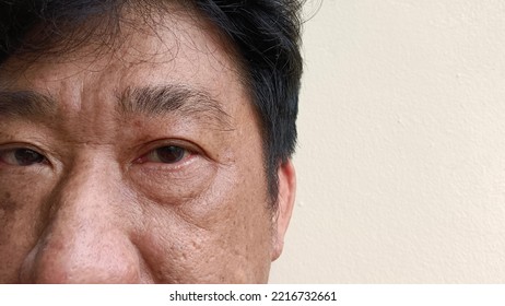 Men's Facial Skin Has Acne Scar, Freckles, Sunburn.