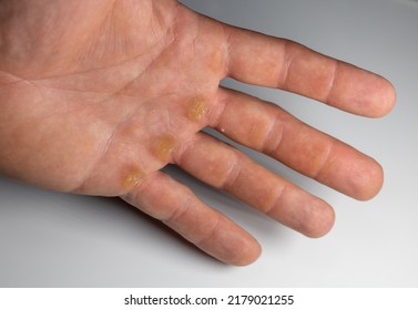 Men's Hand With Corn On White Background. Thick Skin In Hand 
