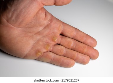 Men's Hand With Corn On White Background. Thick Skin In Hand 
