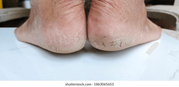 scaly foot skin
