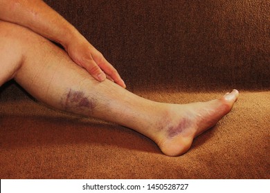 Men's leg with swelling and bruises after stretching the calf muscles and ankle joint