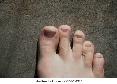 Men's Pedicure At Home. Cut Toenails. Toenails Close-up. Untrimmed Nails, Untidy Manicure.