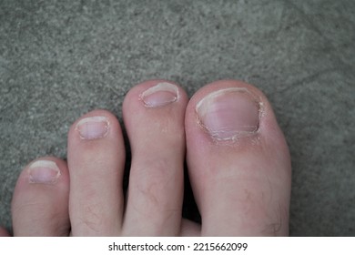 Men's Pedicure At Home. Cut Toenails. Toenails Close-up. Untrimmed Nails, Untidy Manicure.