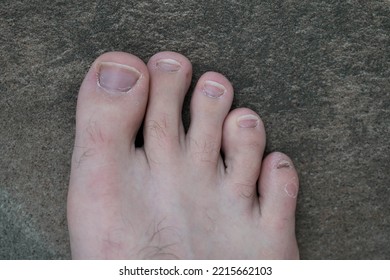 Men's Pedicure At Home. Cut Toenails. Toenails Close-up. Untrimmed Nails, Untidy Manicure.