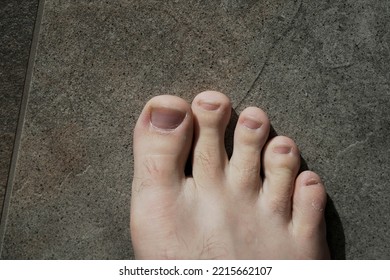 Men's Pedicure At Home. Cut Toenails. Toenails Close-up. Untrimmed Nails, Untidy Manicure.