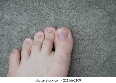 Men's Pedicure At Home. Cut Toenails. Toenails Close-up. Untrimmed Nails, Untidy Manicure.