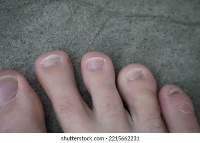 Men's Pedicure At Home. Cut Toenails. Toenails Close-up. Untrimmed Nails, Untidy Manicure.