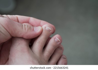 Men's Pedicure At Home. Cut Toenails. Toenails Close-up. Untrimmed Nails, Untidy Manicure.