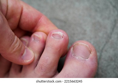 Men's Pedicure At Home. Cut Toenails. Toenails Close-up. Untrimmed Nails, Untidy Manicure.