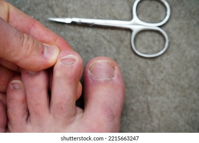 Men's Pedicure At Home. Cut Toenails. Toenails Close-up. Untrimmed Nails, Untidy Manicure.