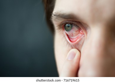 Mens red eye close-up, fatigue, problems with blood vessels